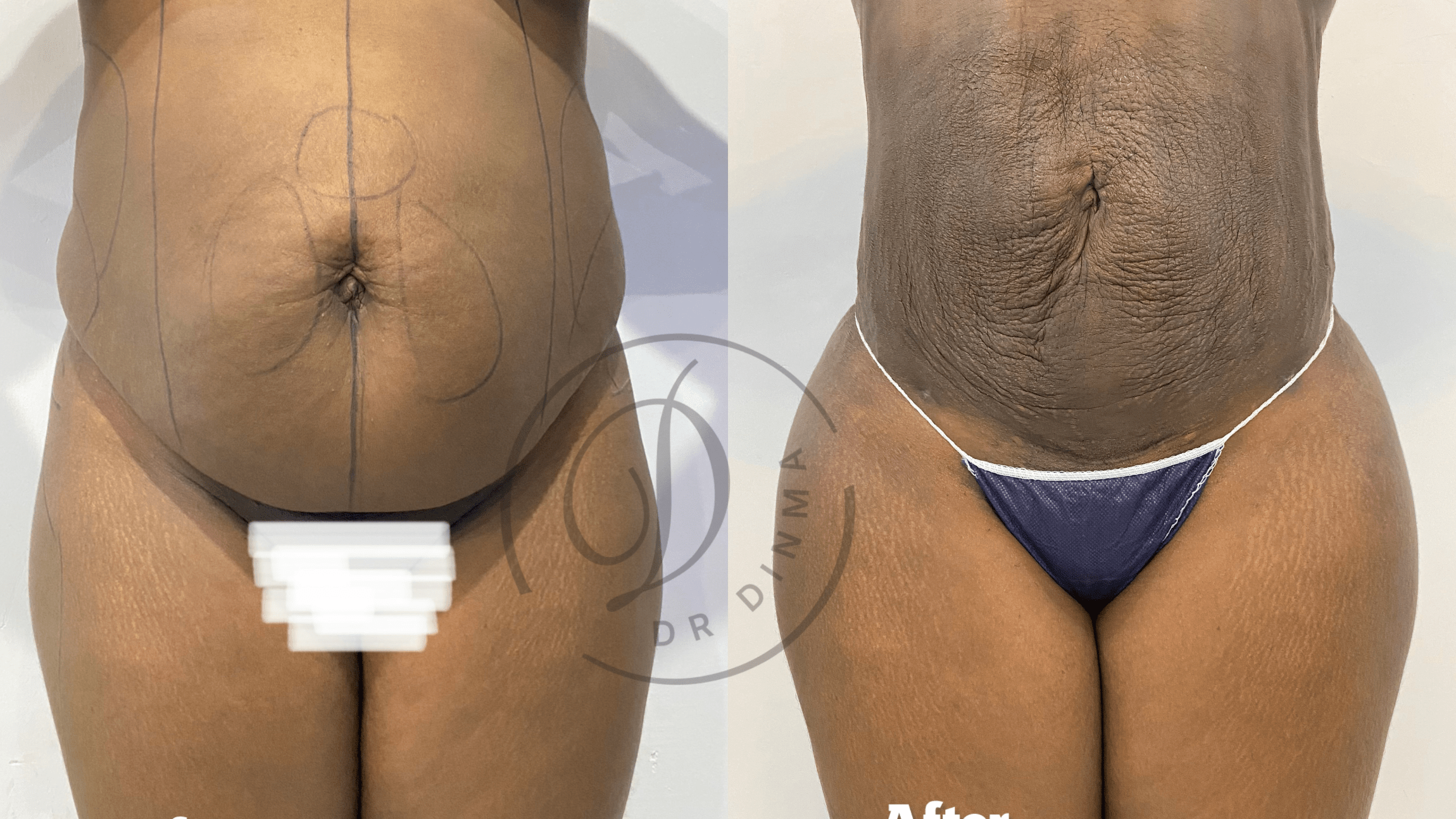 Liposuction
